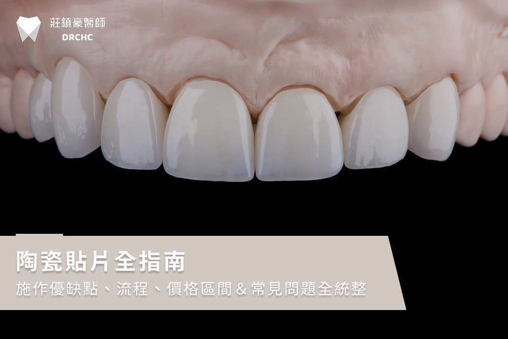 陶瓷貼片全指南，施作優缺點、流程、價格區間＆常見問題全統整
