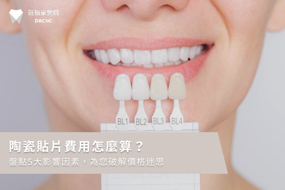 陶瓷貼片費用怎麼算？盤點5大影響因素，為您破解價格迷思
