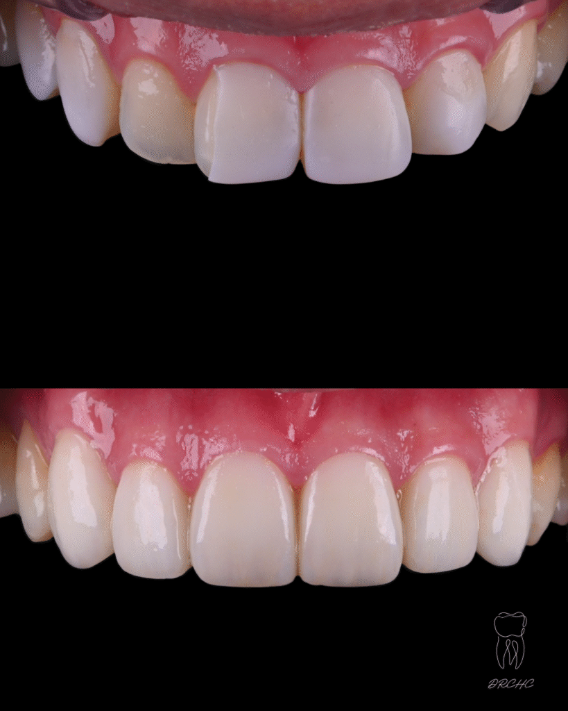 陶瓷貼片Before/after案例一
